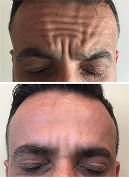 Brotox Results 1